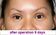 plastic-surgery-blepharoplasty